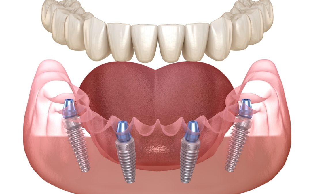 ¿Conoces todas las ventajas de los implantes All On Four?